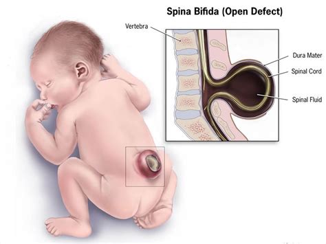 Top 8 Causes Of Spina Bifida Consumer Protect Com 2020