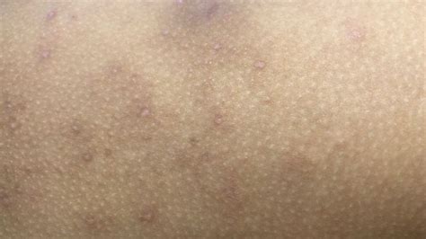 How To Get Rid Of Molluscum Contagiosum Home Guide Expert