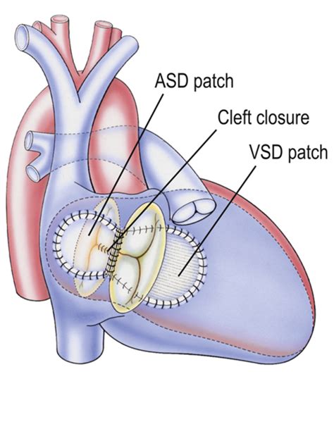 Atrioventricular Septal Defect Avsd Dhzb