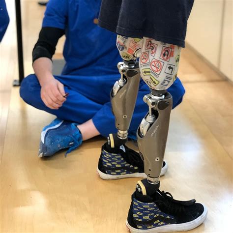 Bilateral Amputee Prosthetic Leg Prosthetics Amputee