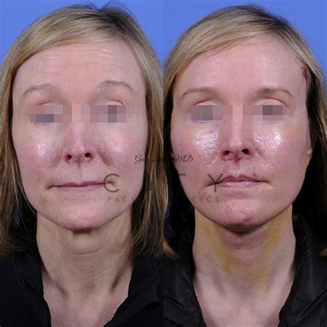 NYC Face Neck Cosmetic Plastic Surgery Procedures New York