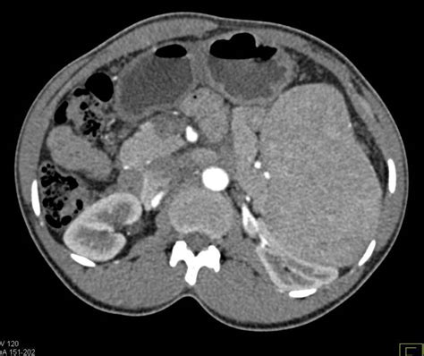 Cll With Marked Splenomegaly Spleen Case Studies Ctisus Ct Scanning