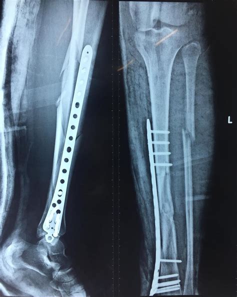 Tibia Shaft Fractures Trauma Orthobullets Com