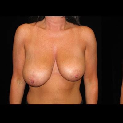 Breast Reduction Dr Benjamin Lam