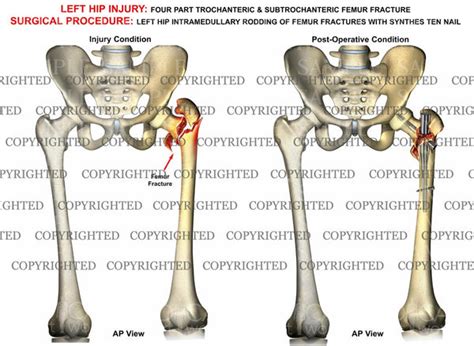 Left Femur 4 Part Intertrochanteric Fracture — Medical Art Works