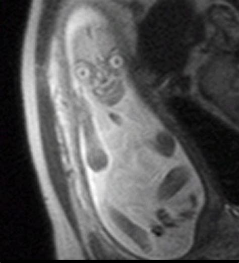 All 98 Images Mri Of A Baby In The Womb Sharp 112023