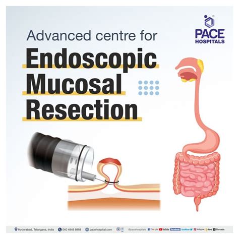 Endoscopic Mucosal Resection Emr Procedure Indications And Cost Pdf