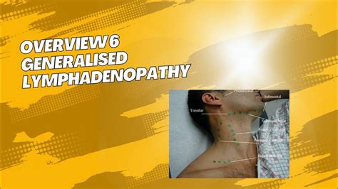 Overview 6 Generalised Lymphadenopathy Youtube