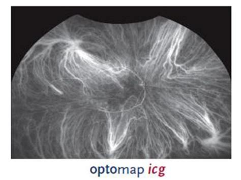Ultra Widefield Retinal Imaging From Optos Plc Dunfermline Fife Uk