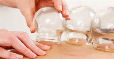 Learn Cupping Therapy Benefits Acusports Therapy