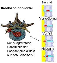 Lernen sie die übersetzung für 'gallertkern' in leos polnisch ⇔ deutsch wörterbuch. Was ist ein Bandscheibenvorfall?