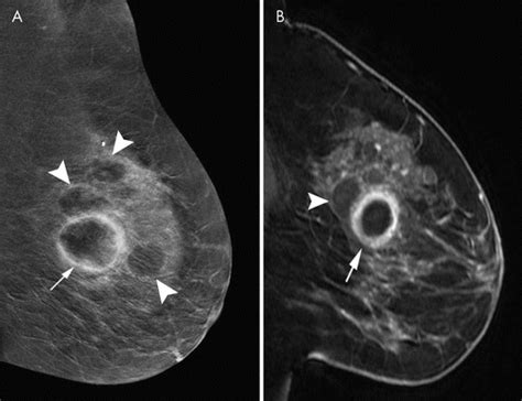 Contrast Enhanced Mammography State Of The Art Radiology