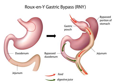Gastric Bypass Surgery Pros And Cons Gb Obesitas