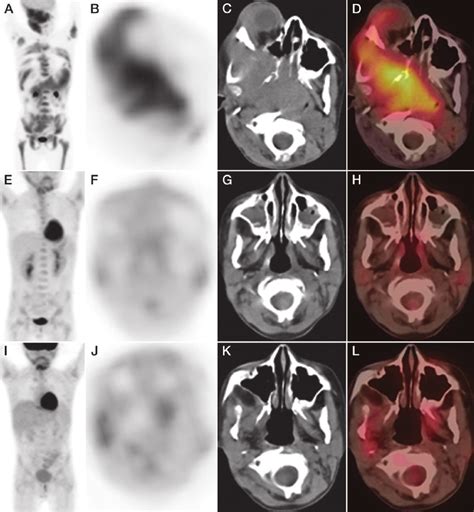 Images In An 8 Year Old Boy With Stage Iv B Cell Lymphoma Who Presented