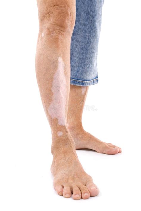 Knee With Vitiligo Skin Condition Stock Image Image Of Healthcare