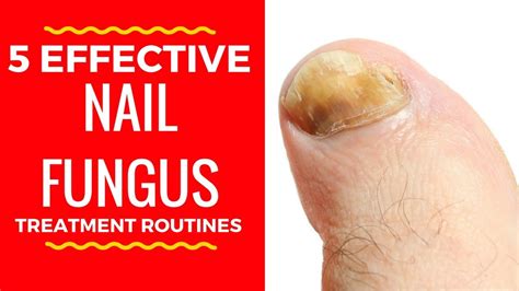 5 Effective Nail Fungus Treatment Routines Home Remedies For Toenail