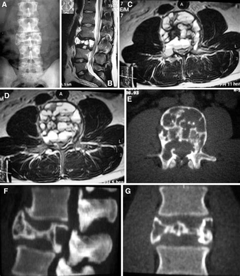 Aneurysmal Bone Cysts Of The Spine Springerlink