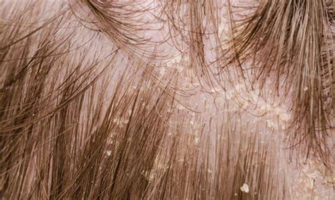 Itchy Scalp Causes And Treatment