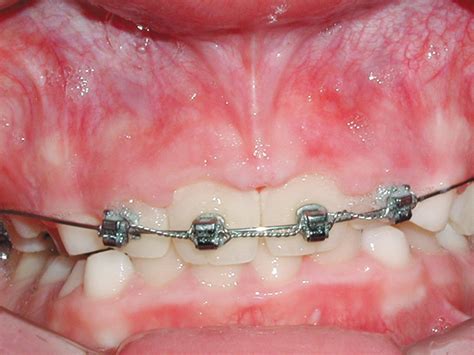Orthodontic Procedures Austin Dentist Mike Williamson Dds Ms