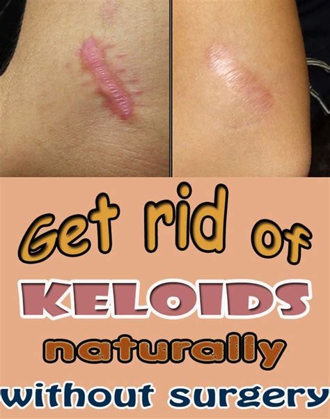 Is There A Way To Remove Keloids Howtormeov