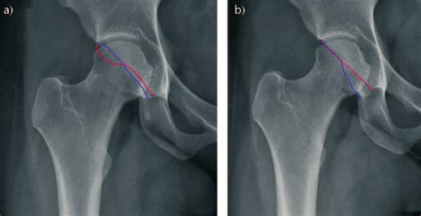 A Pincer Type Impingement Before Hip Arthroscopy The Red Line Shows