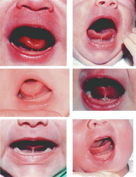 Six Examples Of Babies Diagnosed As Having Tongue Tie Showing The