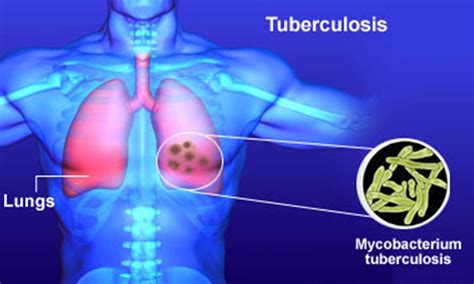 Ciencias Naturales Ceuja 2015 La Tuberculosis