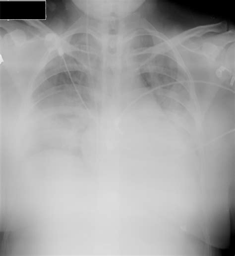 Oxygen therapy has been in use for centuries. High-flow nasal cannula in the treatment of acute hypoxemic respiratory failure in a pregnant ...