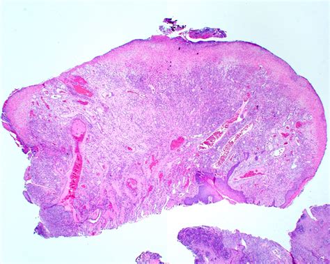 Oral Pyogenic Granuloma Histology