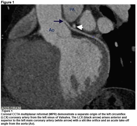 Interarterial Left Circumflex The Forgotten Coronary Artery Anomaly
