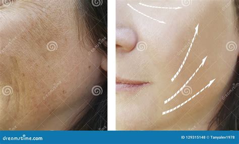 Woman Wrinkles Cosmetology Pigmentation Mature Before And After
