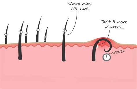 Ingrown Facial Hair How To Prevent And Get Rid Of It For Good
