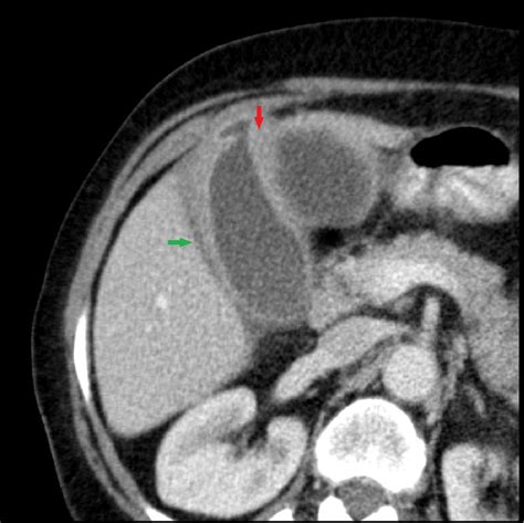 Gallbladder Perforation Radiological Aspects Types And Causes