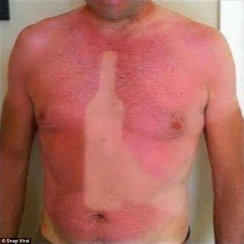 Sunburn Images Show Epic Tan Fails And Bruised Egos To Match Daily Mail Online