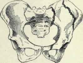 Case contributed by dr mohammad osama hussein yonso ◉. Spiral Humerus Fracture Recovery Time