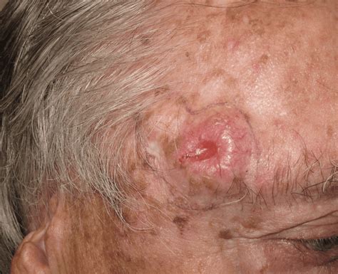 Cancer As Related To Merkel Cell Carcinoma Pictures