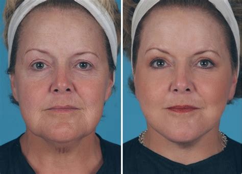 Mini Facelift Atlanta Patient 1 Before And After Photos Front