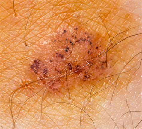 What Are The Most Rare Skin Diseases With Pictures
