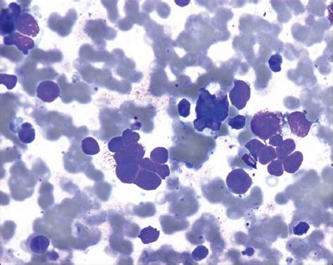 Cytology Smear From Small Cell Carcinoma Of Lung Primary Metastatic