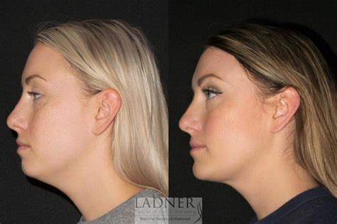 Facial Fat Transfer Liposuction Before And After Pictures Case 68