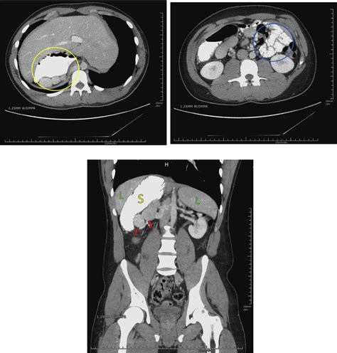 31 Abdominal Ct Axial View Showing A Right Sided Stomach With Oral