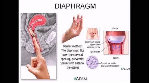 Diaphragm Contraceptive Youtube