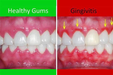 Understanding Gum Disease Causes Symptoms And Treatments Ask The