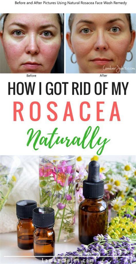 Homemade Natural Face Wash Remedies For Rosacea Get Rid Of Redness And