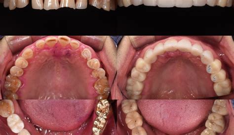 Composite Resin Rehabilitation Of Worn Down Dentition Myzerodonto