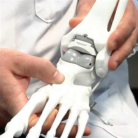 Foot Ankle Joint Replacement Surgery Explained Precision Orthopaedic