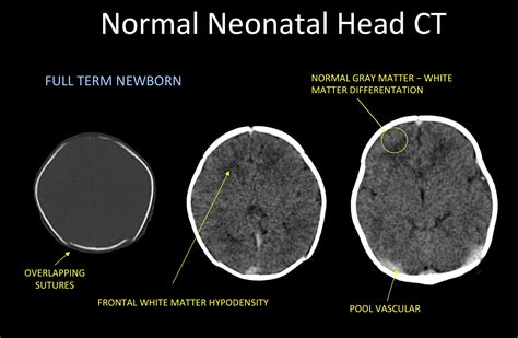Normal Ct Brain