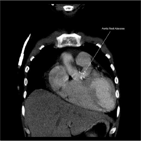 Ct Scan Image Of Aortic Root Abscess Figure 3 Aortic Root