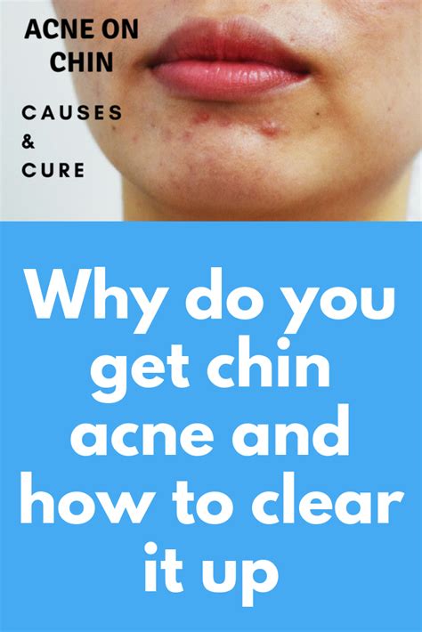 How To Get Rid Of Chin Acne Sylviaweems