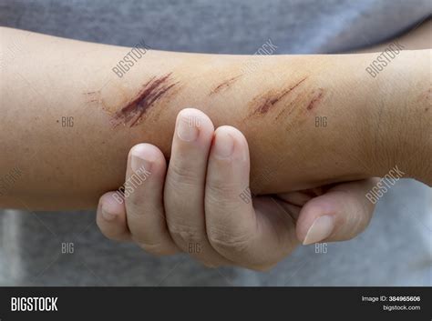 Wound Form Scabs On Image And Photo Free Trial Bigstock